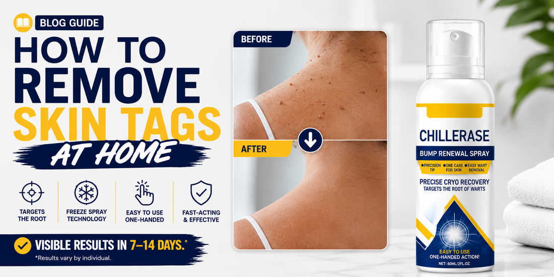 How to Remove Skin Tags at Home: A Simple Guide