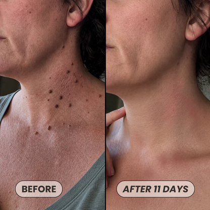 Skin Tag Removal