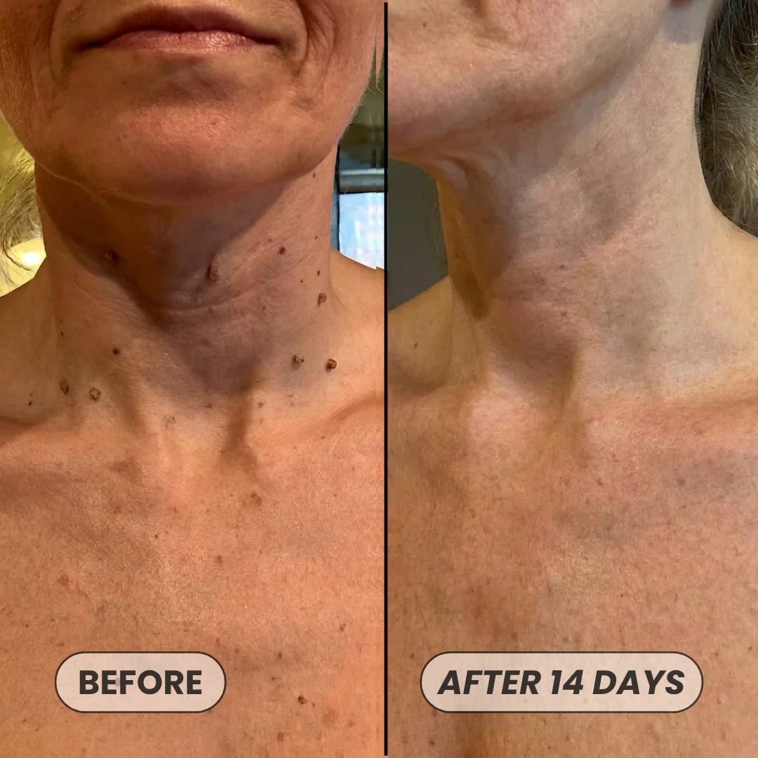 Skin Tag Removal