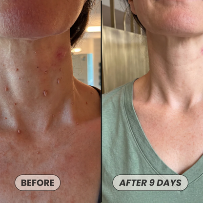 Skin Tag Removal