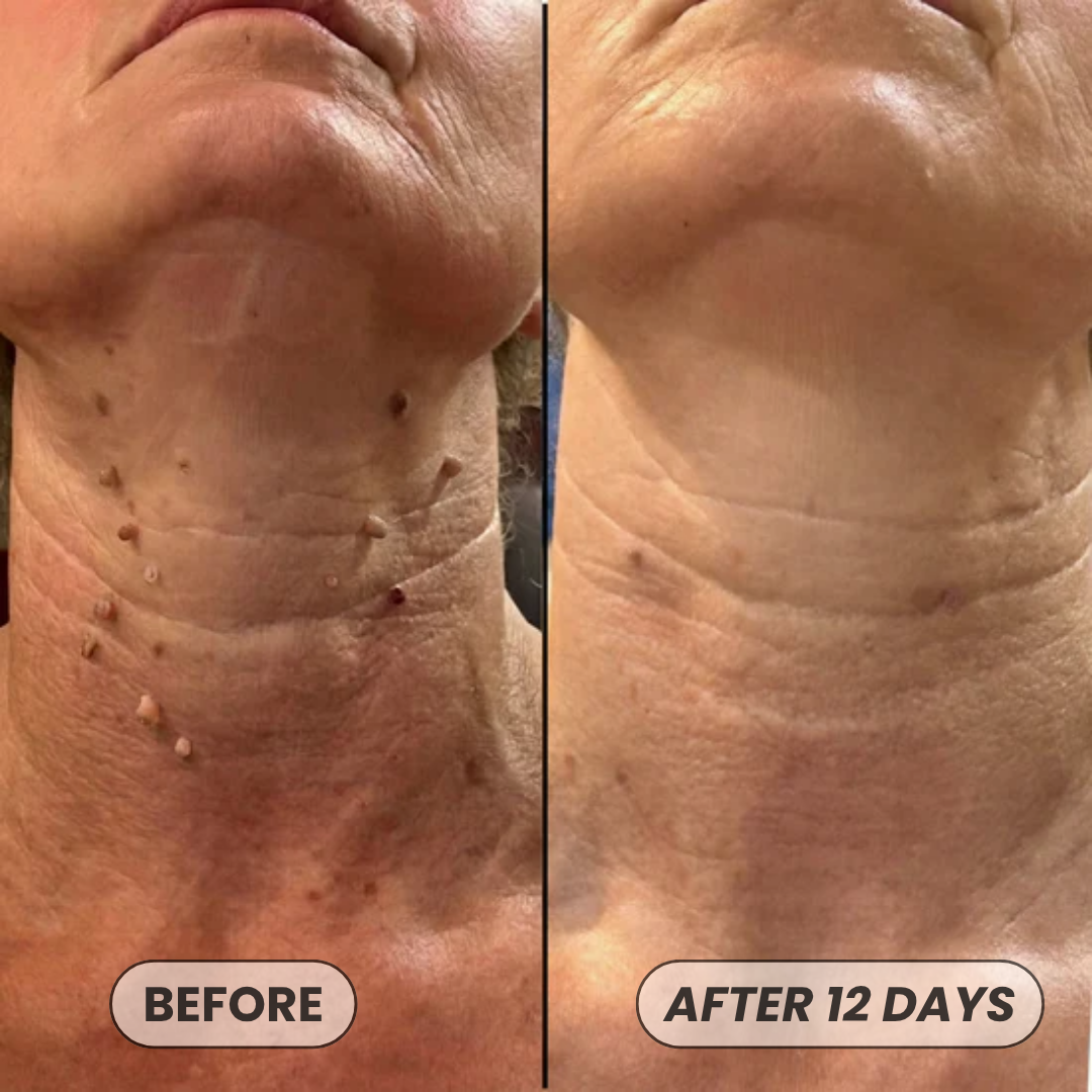 Skin Tag Removal